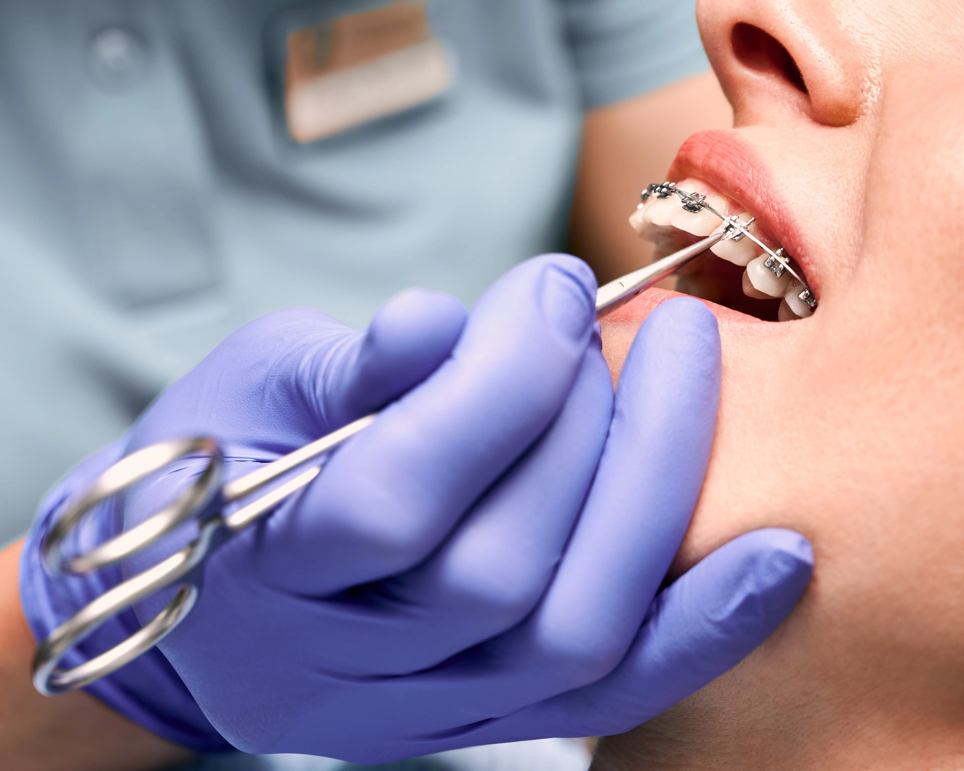 Composite Bonding